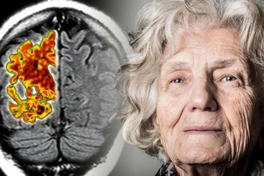 Ученые назвали 4 малоизвестных признака развития болезни Альцгеймера